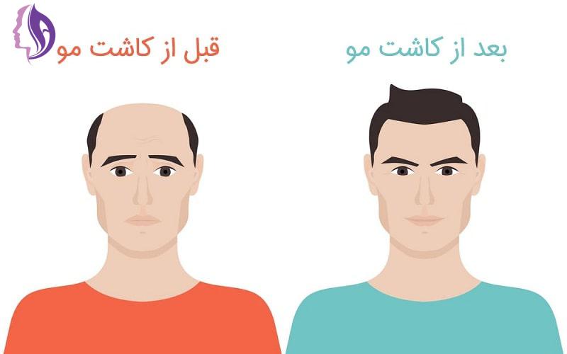 بهترین روش کاشت مو در ایران چیست ؟