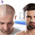 عوامل تاثیرگذار بر میزان موفقیت کاشت مو
