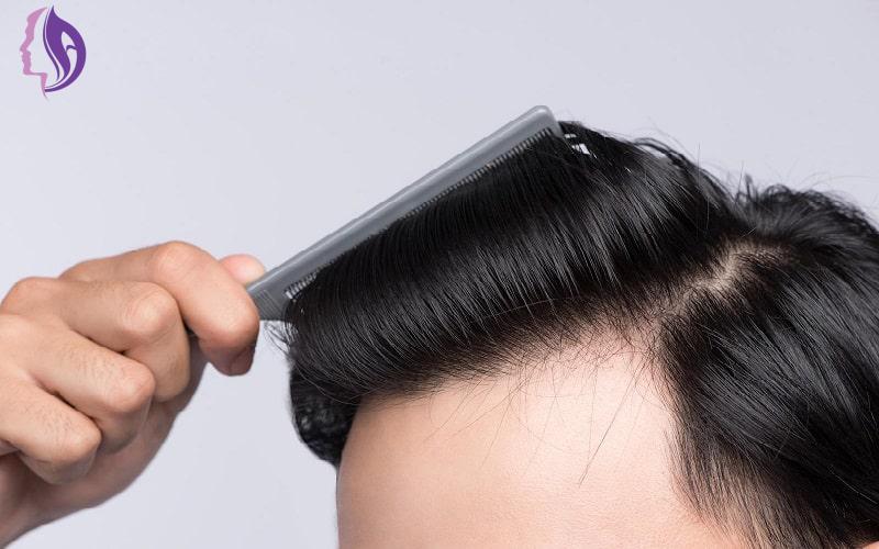 کاشت مو چقدر موفق است؟